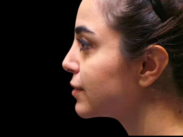 Chin Augmentation Patient 03 After 1