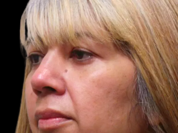 Eyelid Surgery Patient 03 After 1