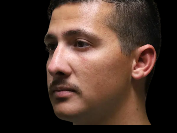 Rhinoplasty Patient 49 After 2