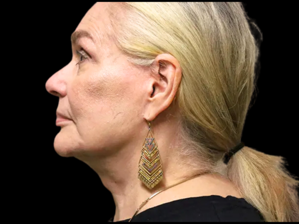 FaceLift Patient 15 After 3