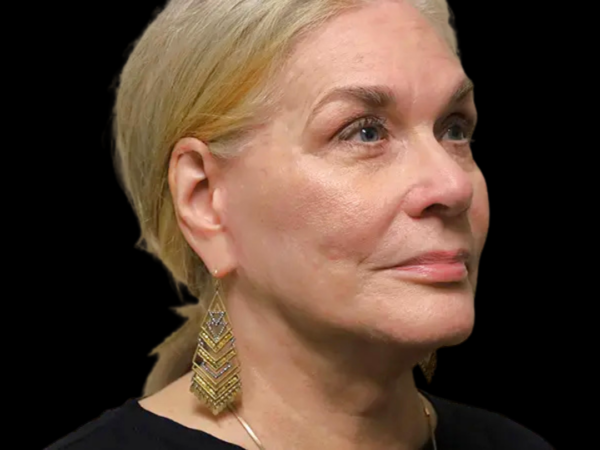 FaceLift Patient 15 After 2