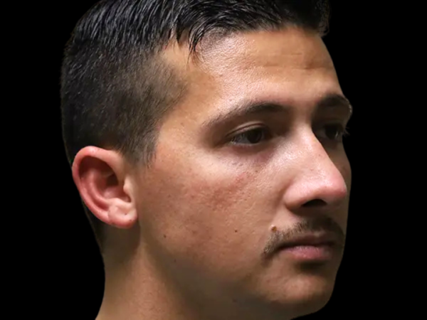 Rhinoplasty Patient 49 After 1