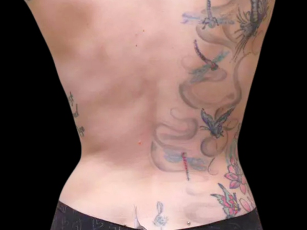 Liposuction Patient 01 After 2