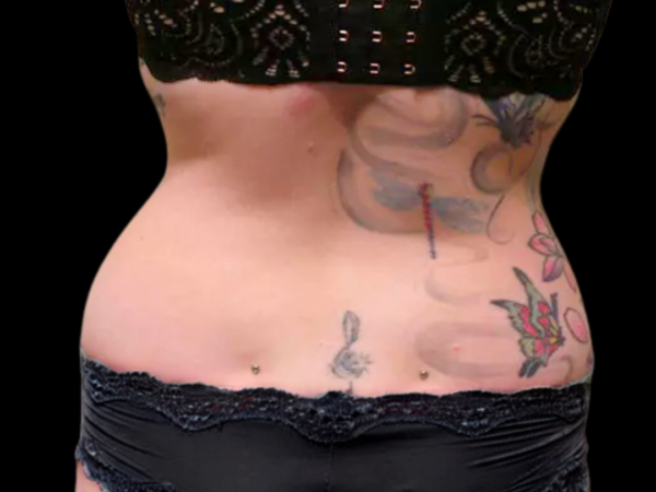 Liposuction Patient 01 Before 2