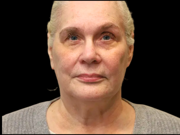 FaceLift Patient 15 Before 1