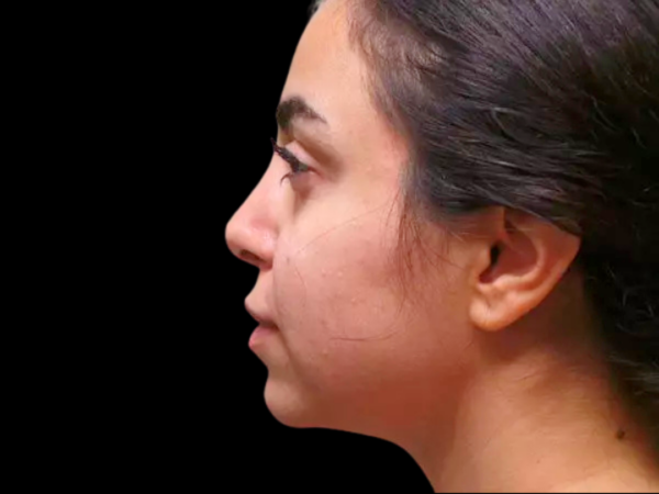 Chin Augmentation Patient 03 Before 1