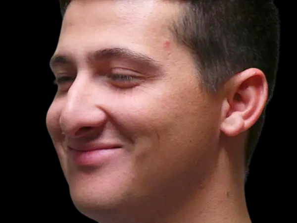 Rhinoplasty Patient 49 Before 2