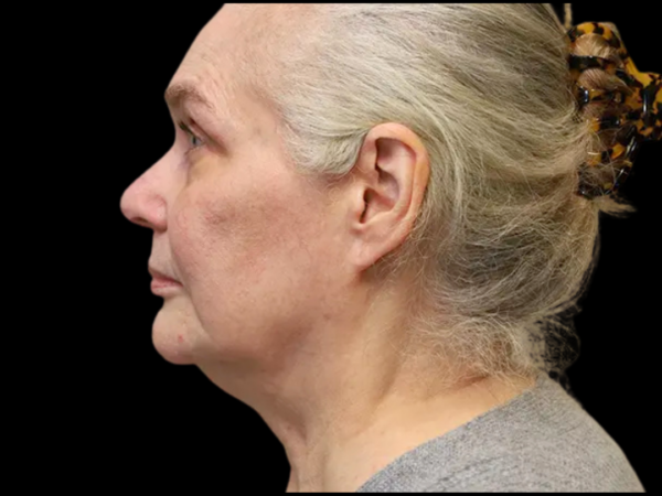 FaceLift Patient 15 Before 3