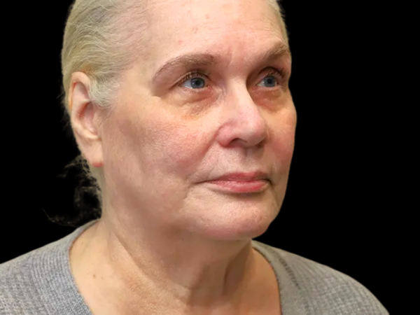 FaceLift Patient 15 Before 2