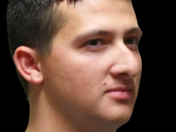 Rhinoplasty Patient 49 Before 1