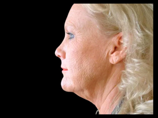 Brow Lift Patient 02 Before 2