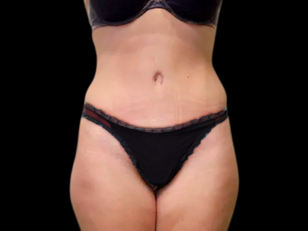 Tummy Tuck Patient 22 After 1