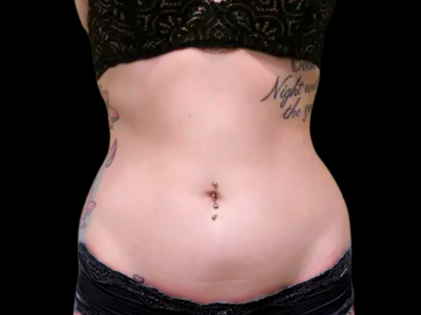 Liposuction Patient 01 Before 1