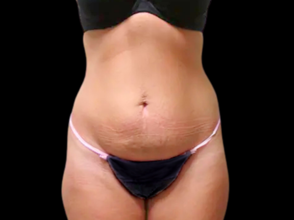 Tummy Tuck Patient 22 Before 1