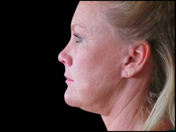 Brow Lift Patient 02 After 2