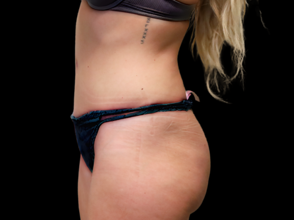 Tummy Tuck Patient 22 After 2