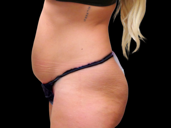 Tummy Tuck Patient 22 Before 2
