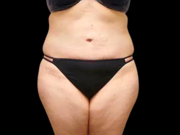 Tummy Tuck Patient 08 After 1