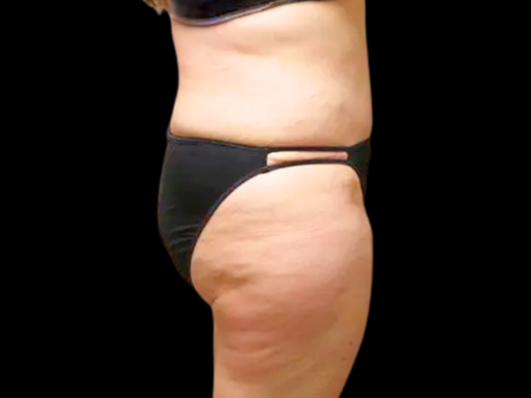 Tummy Tuck Patient 08 After 2