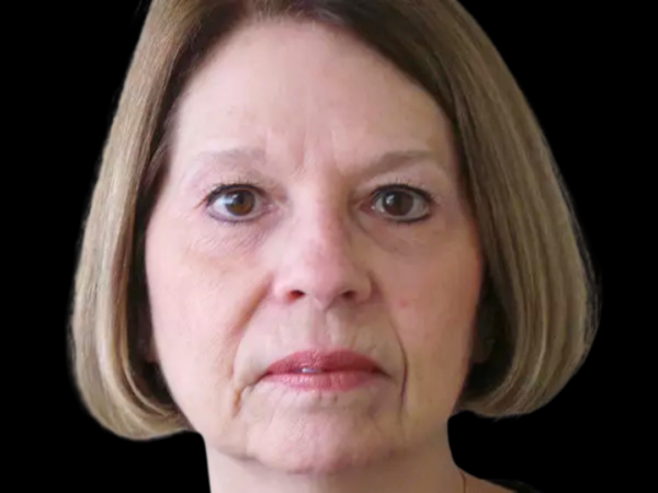 Eyelid Surgery Patient 10 After 1