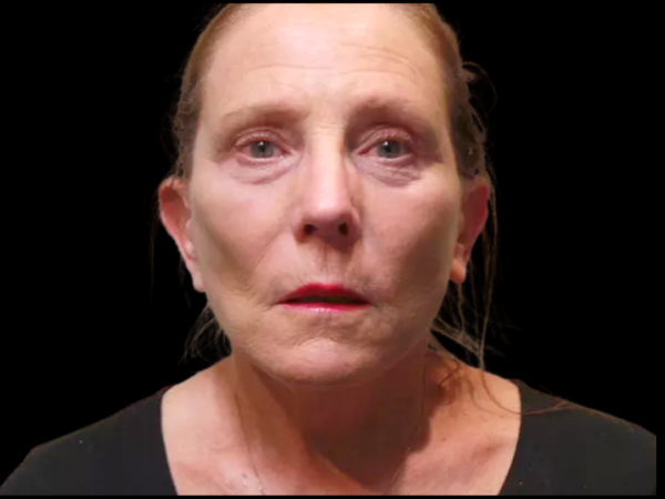 Facelift Patient 08 After 1