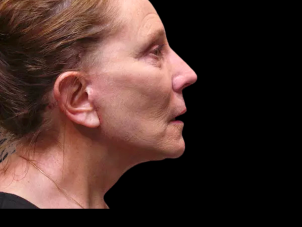 Facelift Patient 08 After 2