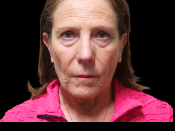 Facelift Patient 08 Before 1