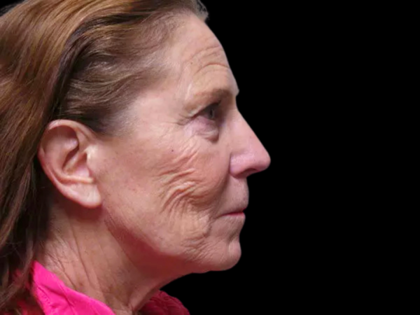 Facelift Patient 08 Before 2