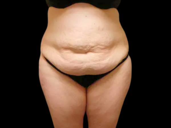 Tummy Tuck Patient 08 Before 1