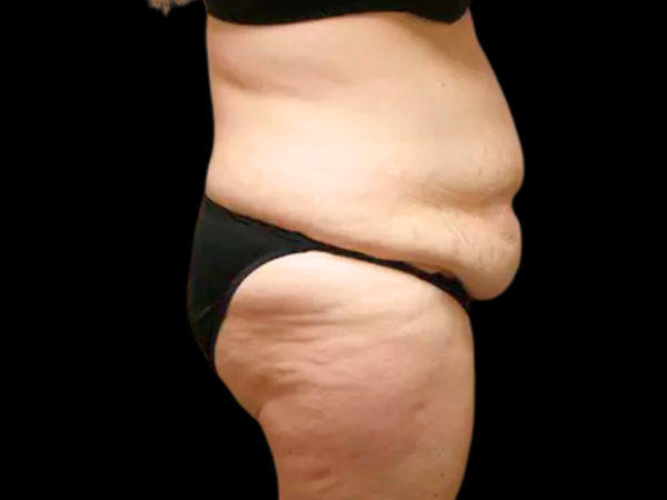 Tummy Tuck Patient 08 Before 2