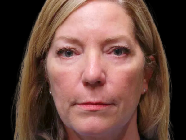 Eyelid Surgery Patient 09 After 1