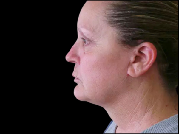 FaceLift Patient 07 After 1