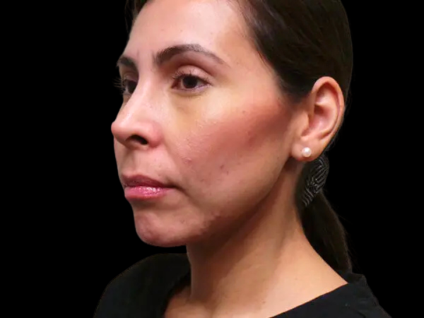 RHINOPLASTY PATIENT 02 After 1