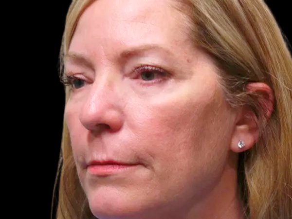 Eyelid Surgery Patient 09 After 2