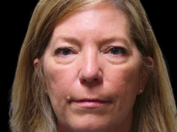 Eyelid Surgery Patient 09 Before 1