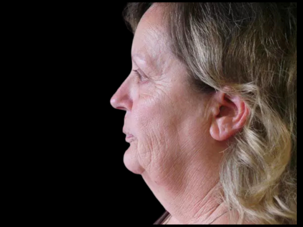 FaceLift Patient 07 Before 1