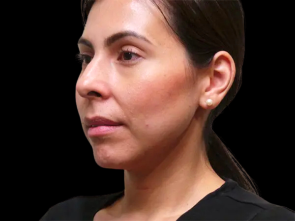 RHINOPLASTY PATIENT 02 Before 1