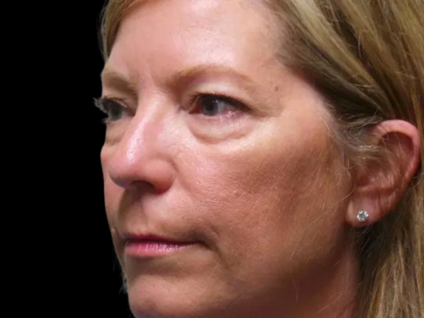 Eyelid Surgery Patient 09 Before 2