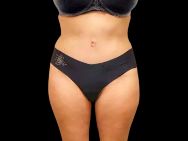 Tummy Tuck Patient 09 After 1