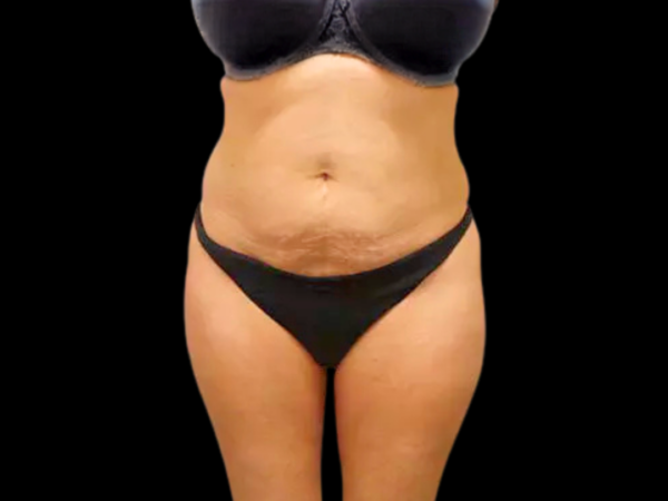 Tummy Tuck Patient 09 Before 1