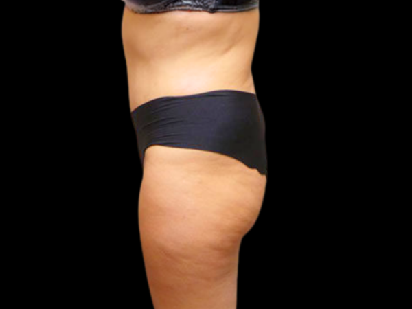 Tummy Tuck Patient 09 After 2