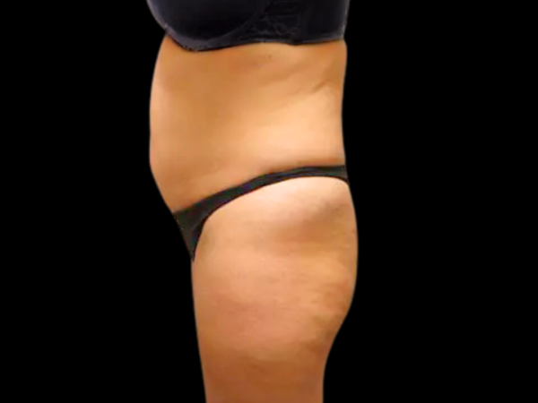 Tummy Tuck Patient 09 Before 2