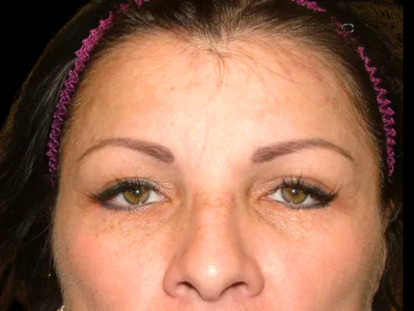 Eyelid Surgery Patient 07 After 2