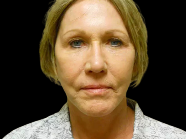 Facelift Patient 12 After 1