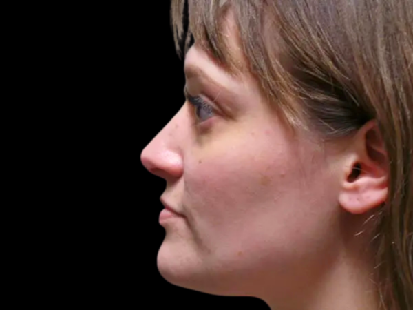 Rhinoplasty Patient 04 After 1