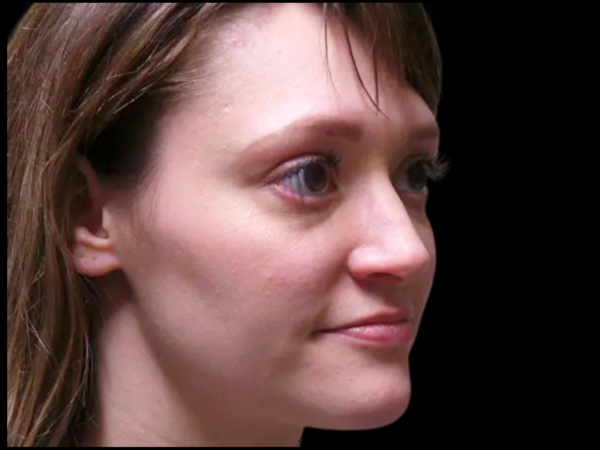 Rhinoplasty Patient 04 After 2