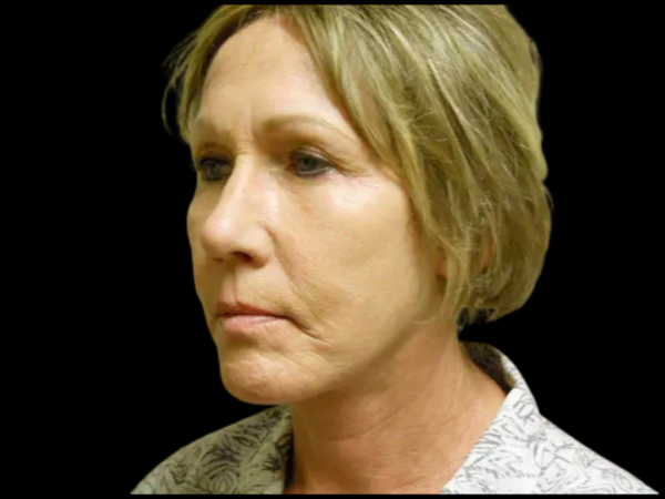 Facelift Patient 12 After 2