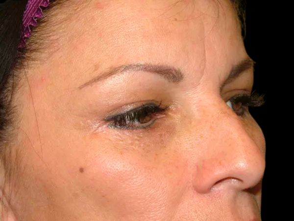 Eyelid Surgery Patient 07 After 1
