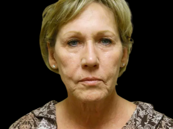 Facelift Patient 12 Before 1