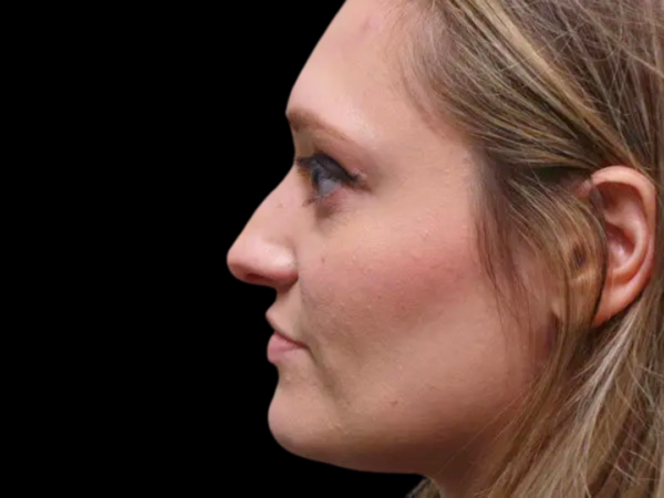 Rhinoplasty Patient 04 Before 1